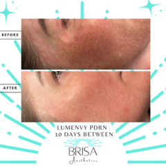 PDRN Lumenvy before and after 1