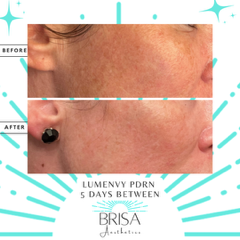 PDRN Lumenvy before and after 3