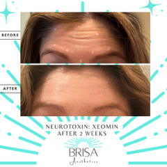 Forehead wrinkle relaxer before and after