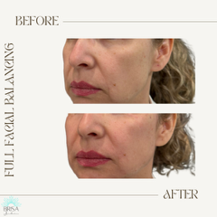 Full facial balancing before and after 2