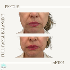 Full facial balancing before and after 5
