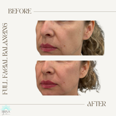 Full facial balancing before and after 7