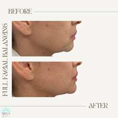 Full facial balancing before and after 8