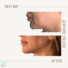 Jawline filler before and after 1