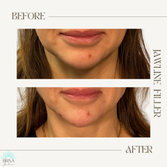 Jawline filler before and after 2 alt