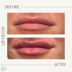 Lip filler before and after 5