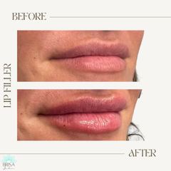 Lip filler before and after 7