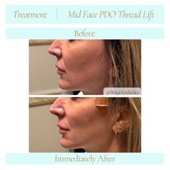 Midface PDO thread lift