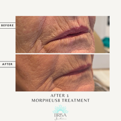 Morpheus8 before and after 1 treatment