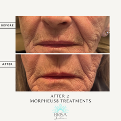 Morpheus8 before and after 2 treatments