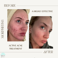 Morpheus8 acne treatment before and after