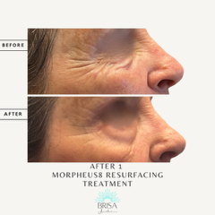Morpheus8 resurfacing before and after
