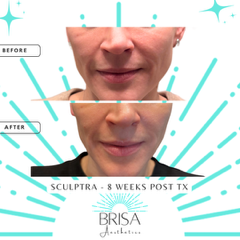 Sculptra 8 weeks before and after