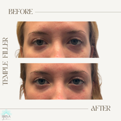 Temple filler before and after