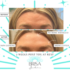 Wrinkle relaxer before and after 1