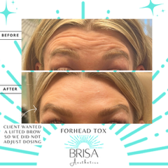 Wrinkle relaxer before and after 2