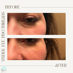 Under eye PDO threads before and after