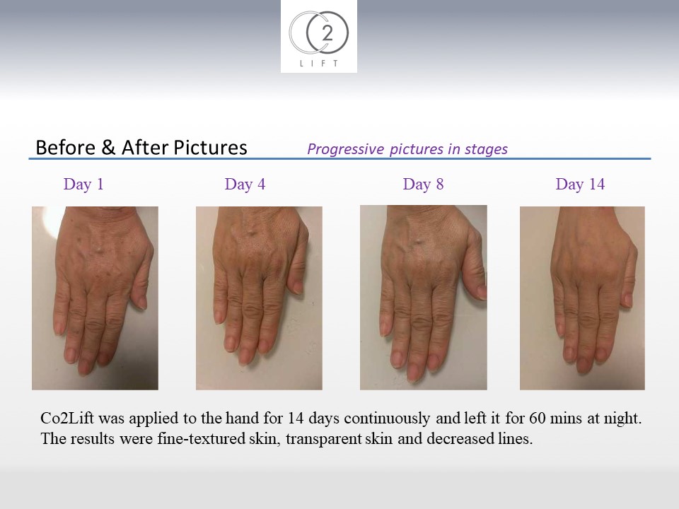CO2LIFT Pro hands before and after