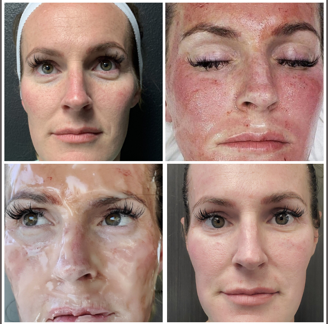 CO2LIFT Pro directly after microneedling