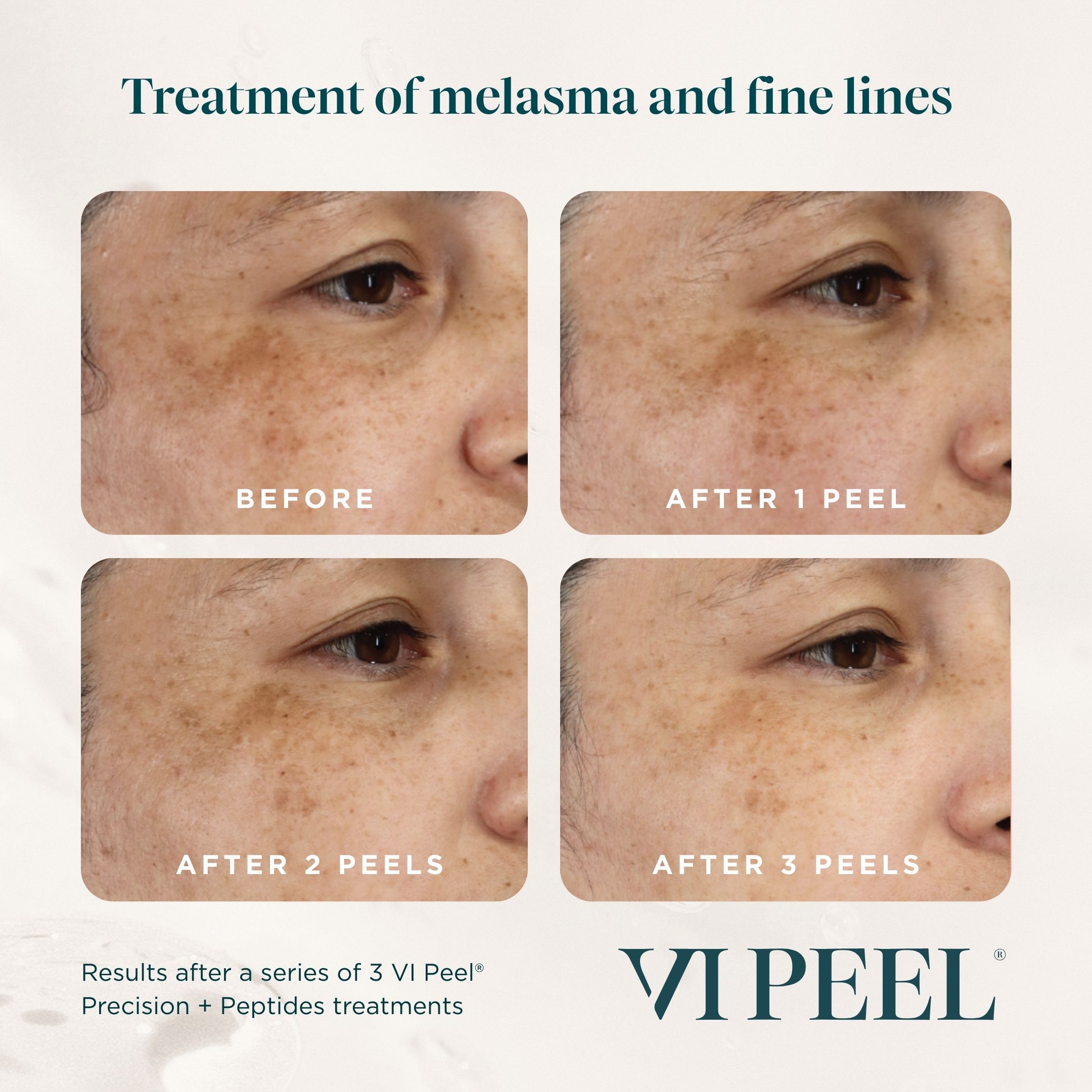 VI Peel skin progression before and after