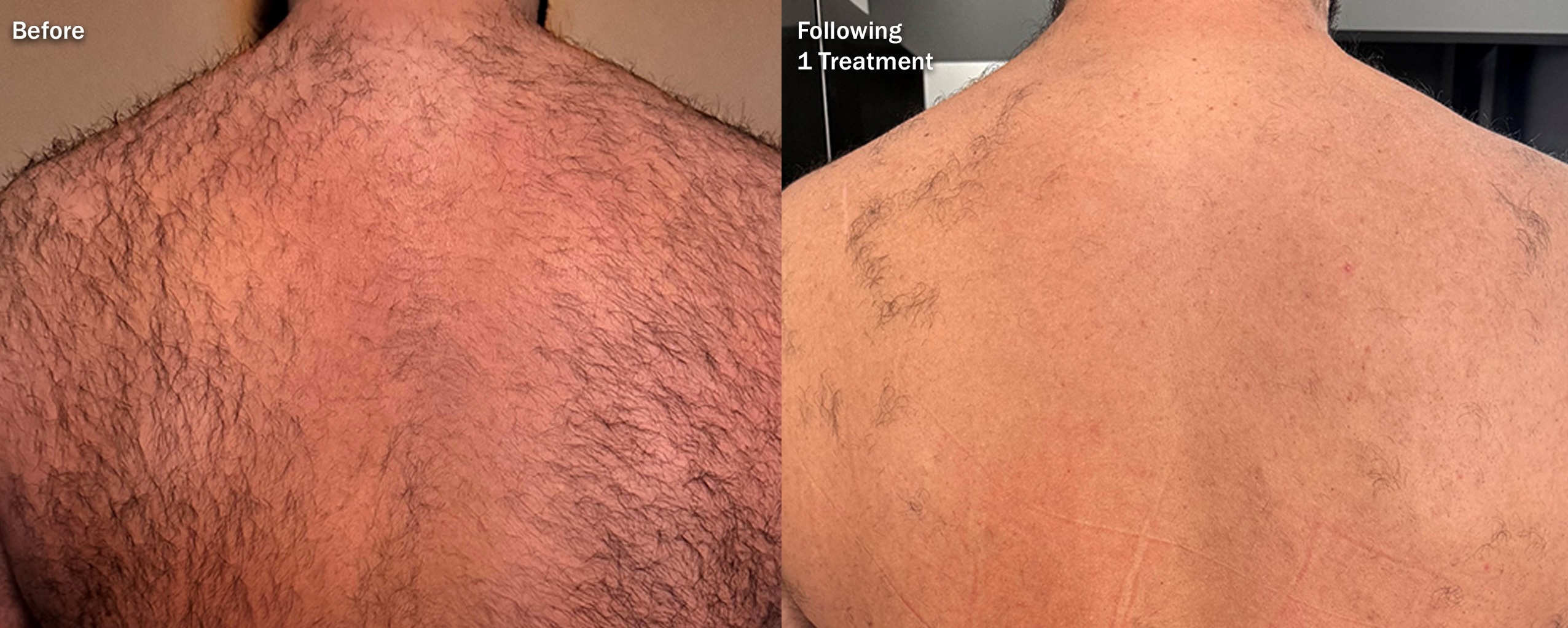 Men's back laser hair removal with Diolaze XL