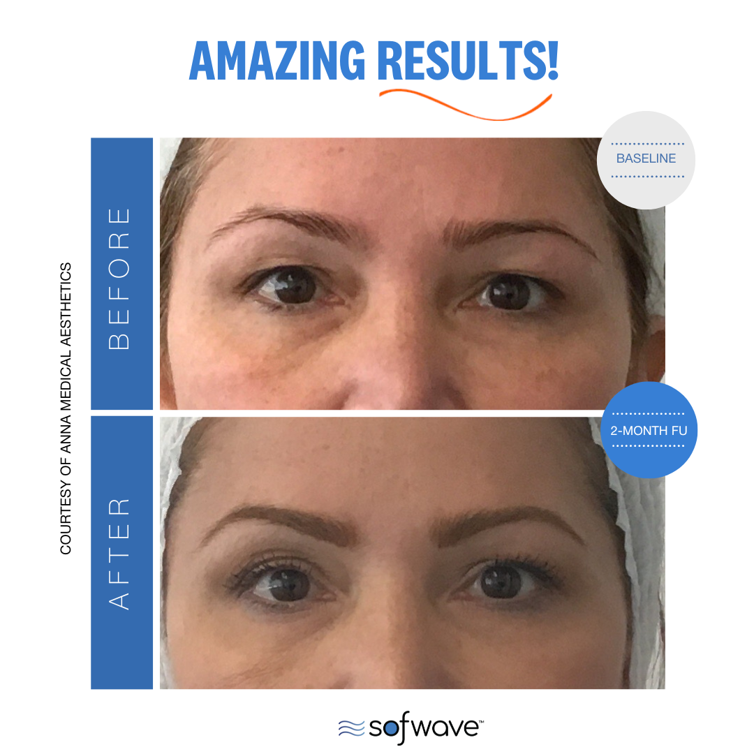 Sofwave eyebrow before and after