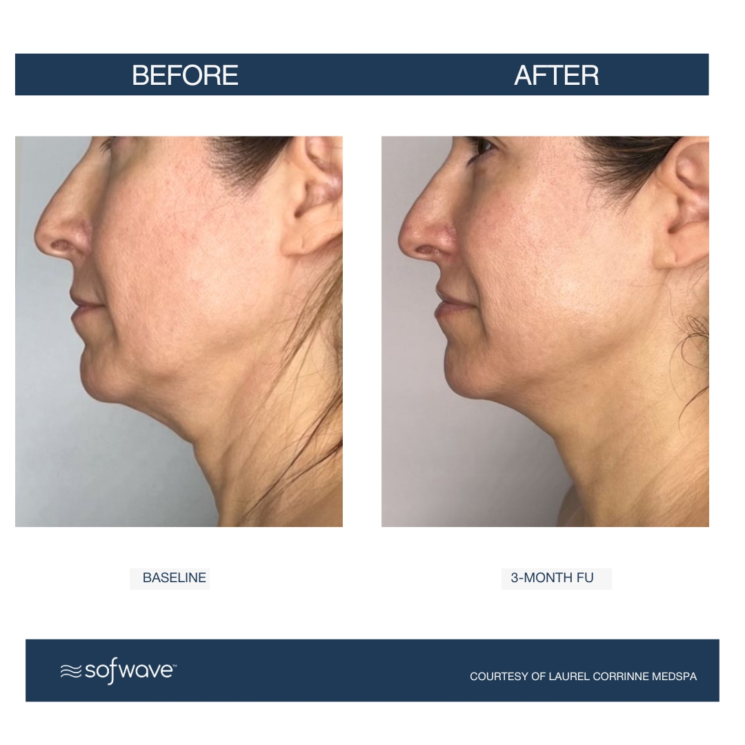 Sofwave submental before and after