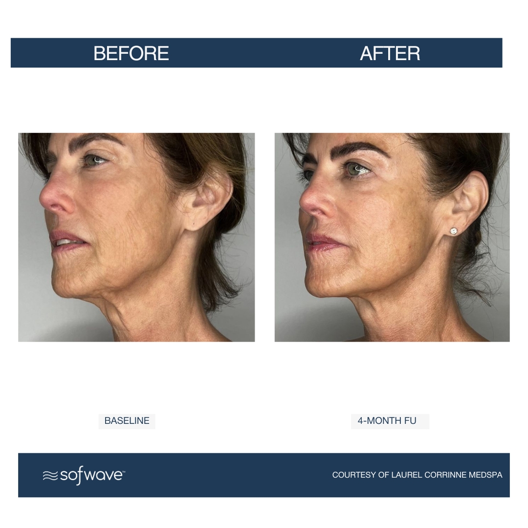 Sofwave face and neck before and after 2
