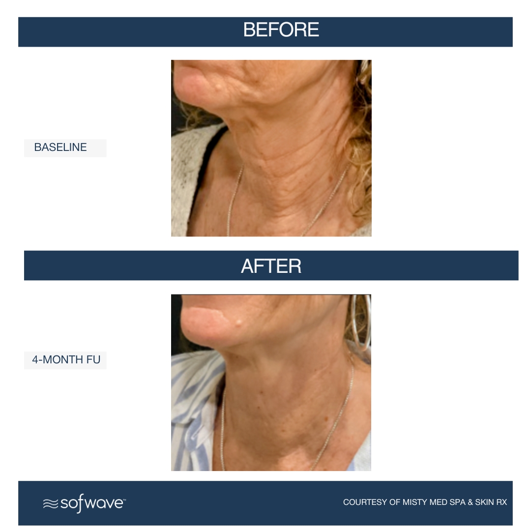 Sofwave face and neck before and after 1