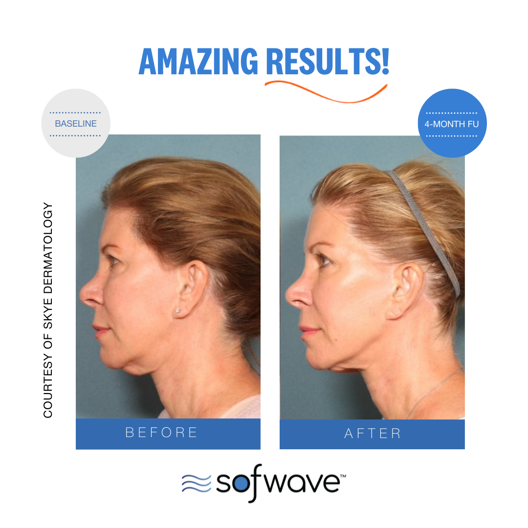 Sofwave before and after clinical result