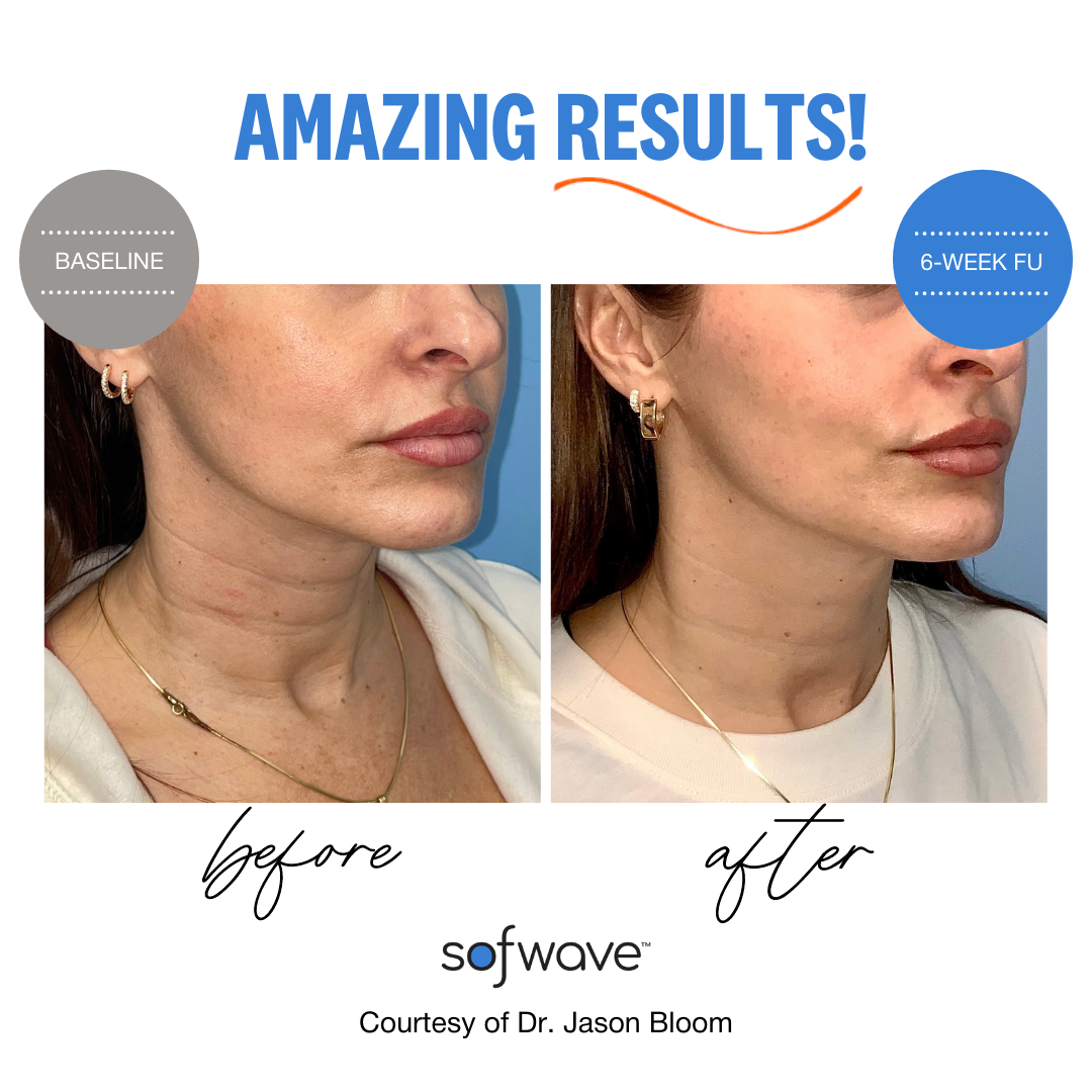 Sofwave baseline and six week follow-up result example
