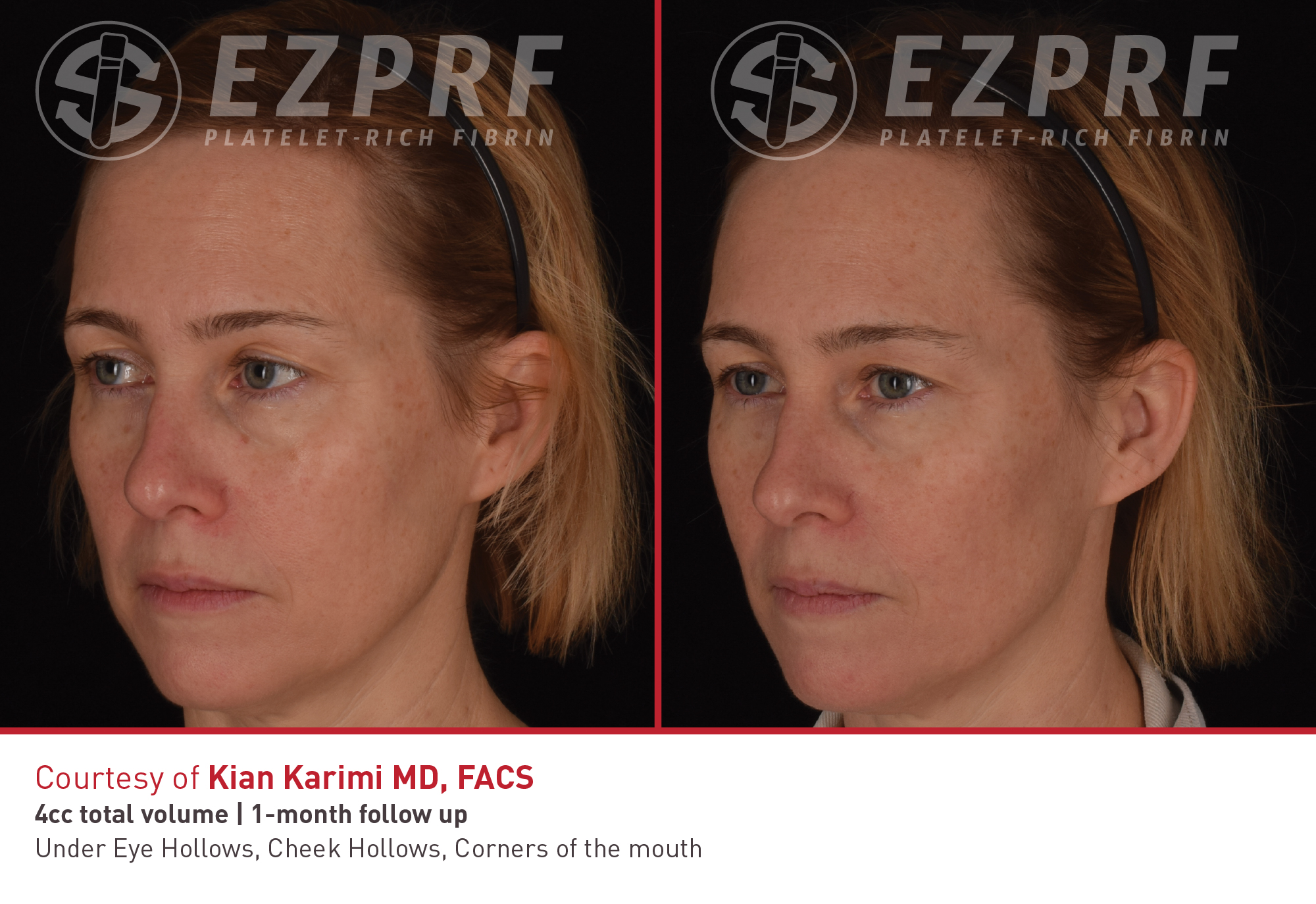 PRF facial rejuvenation before and after result