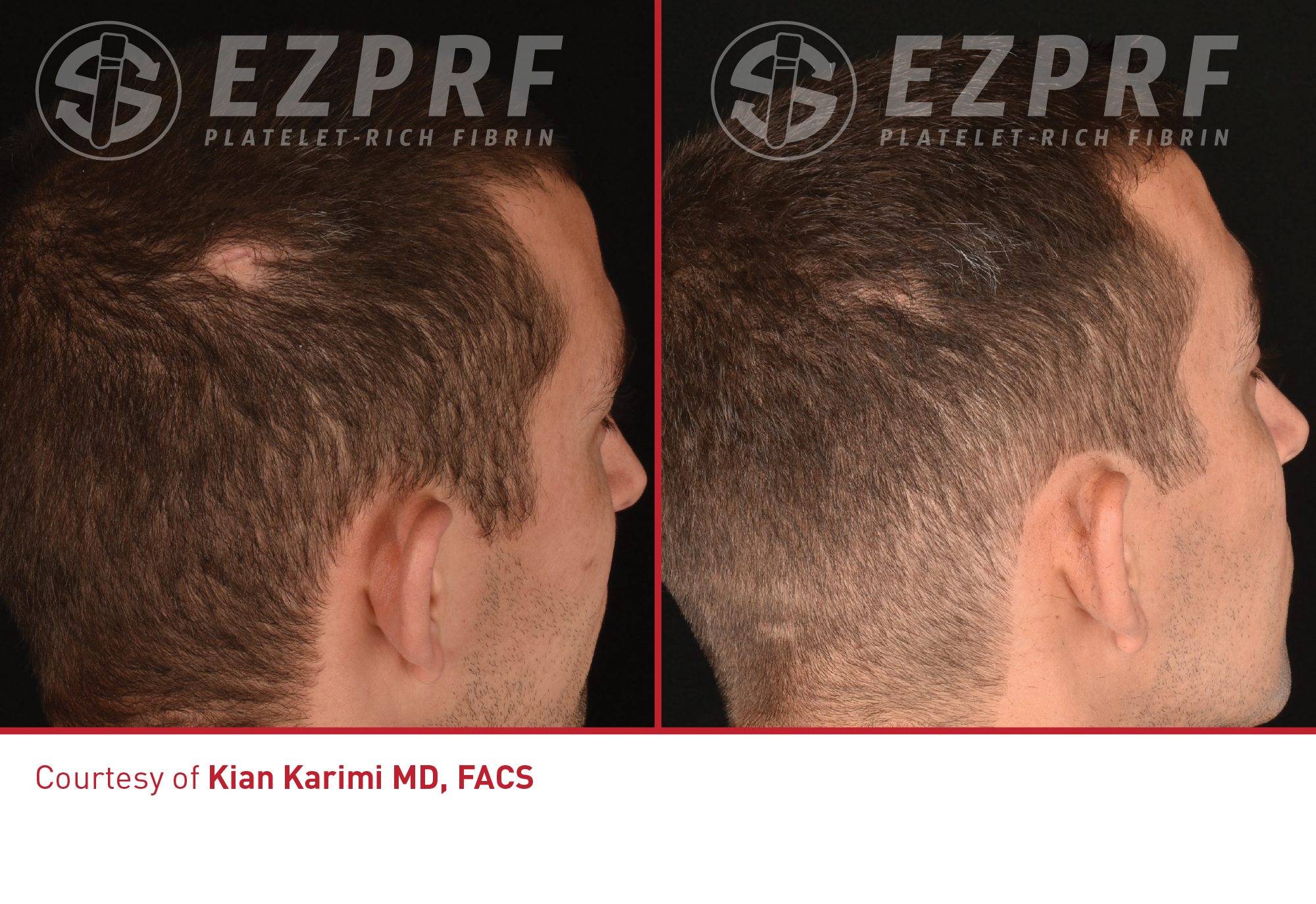 PRF hair restoration before and after