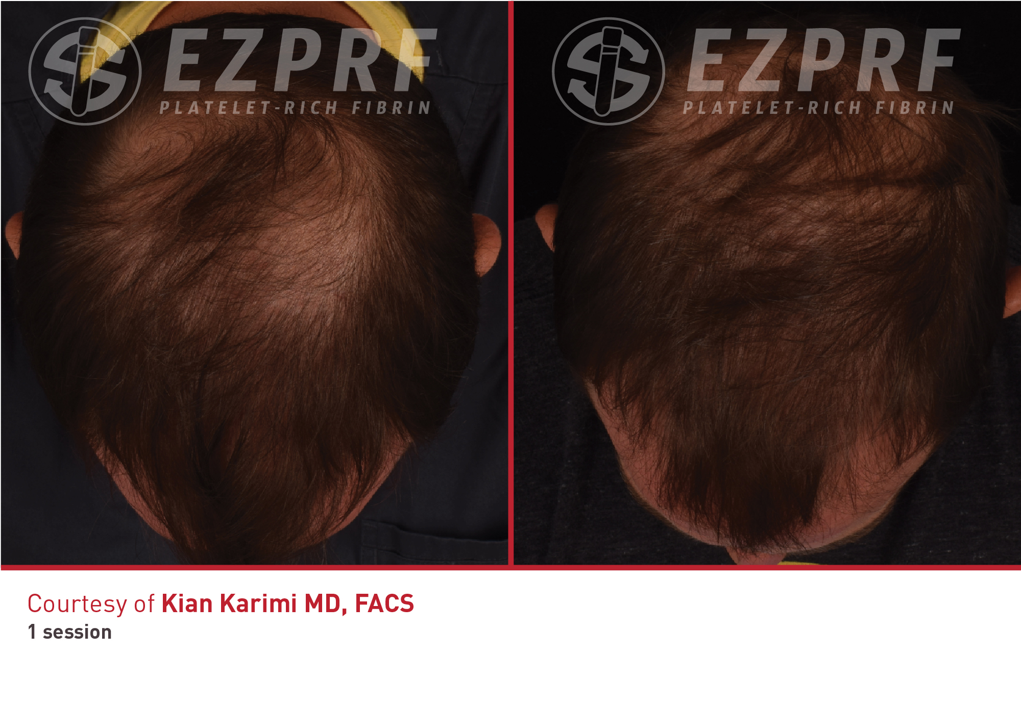 PRF hair restoration before and after result
