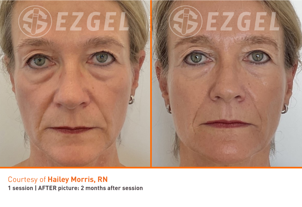 EZGEL regenerative treatment experience