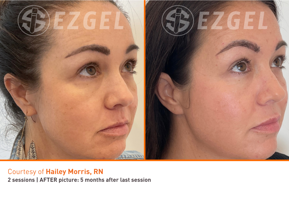 PRF EZGEL regenerative aesthetic treatment