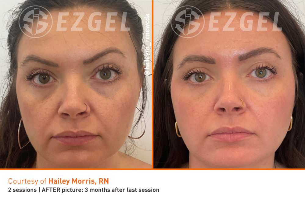 EZGEL treatment at Brisa Aesthetics