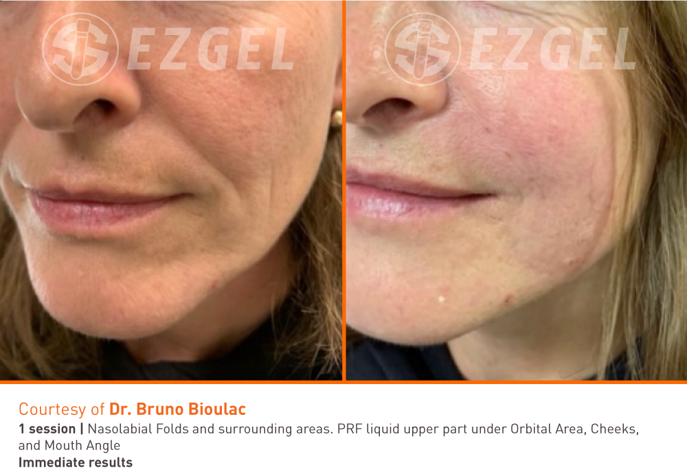 PRF EZGEL facial treatment