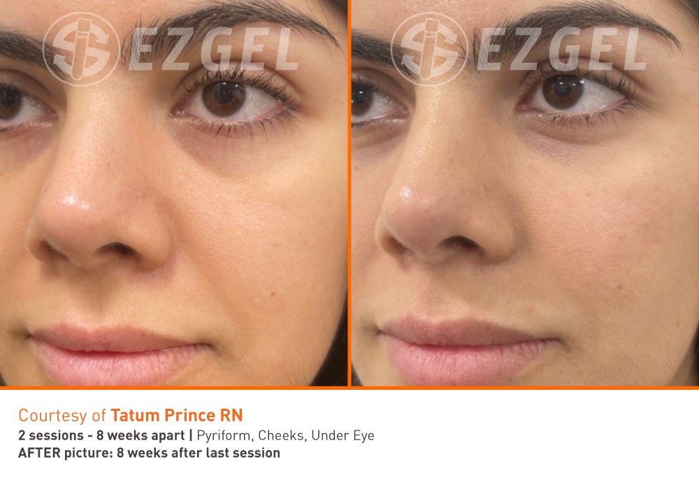 PRF EZGEL treatment at Brisa Aesthetics in Weymouth Massachusetts