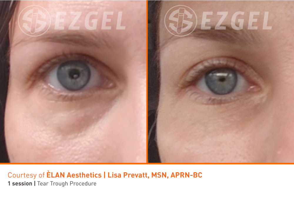 PRF EZGEL treatment process at Brisa Aesthetics