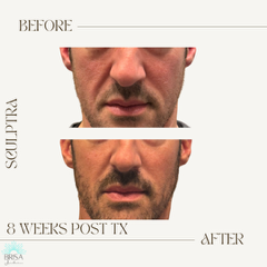 Sculptra 8 wks DB