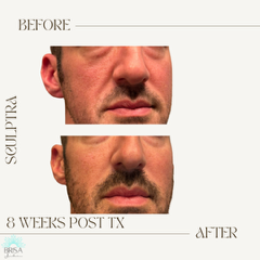 Sculptra 8 wks DB10