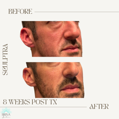 Sculptra 8 wks DB11