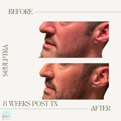 Sculptra 8 wks DB6