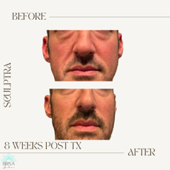 Sculptra 8 wks DB7