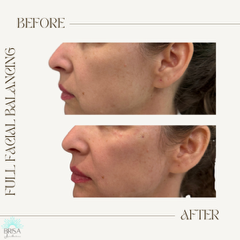 full facial balancing 3