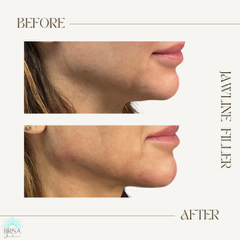 jawlinefiller2