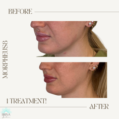 m8 after 1 treatment NL folds