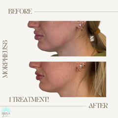 m8 after 1 treatment jawline