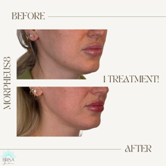 m8 after 1 treatment submental area